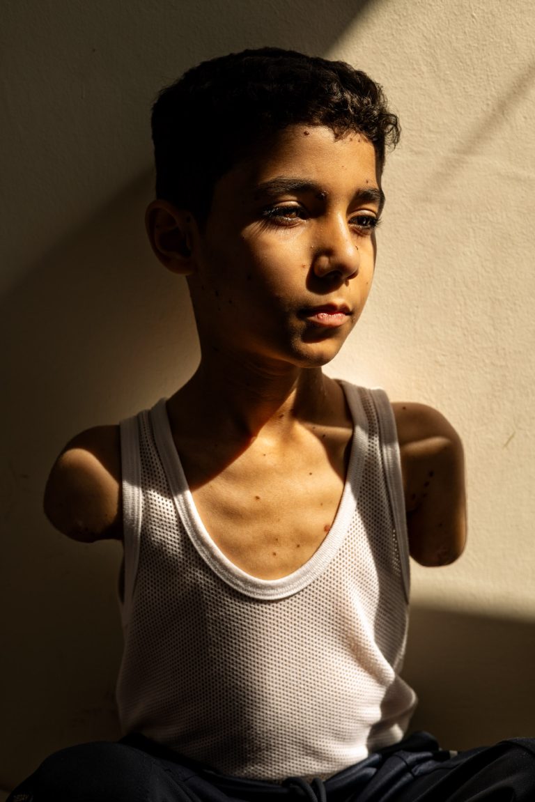Mahmoud Ajjour, 9 years old, had both arms amputated in a bombing in Gaza City and is now receiving treatment in Qatar. In Qatar, 28 June . ,2024