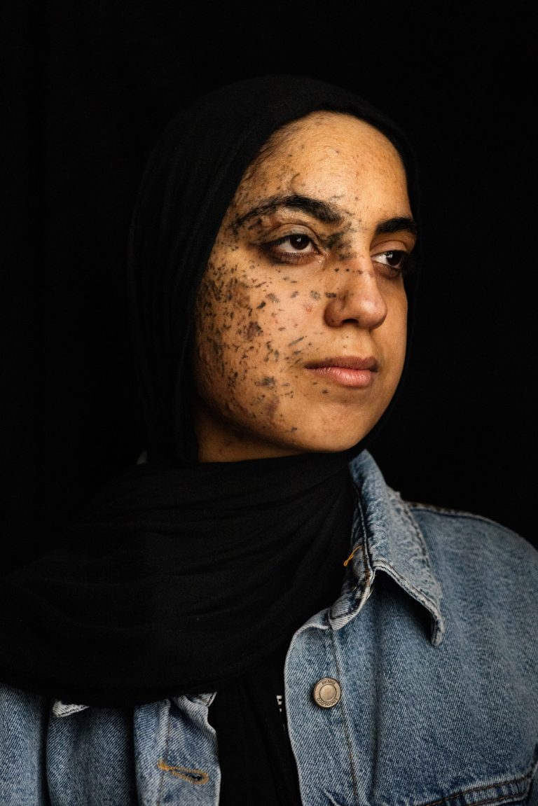 Basant Al-Louh suffered chemical burns, shrapnel wounds to her face, and an amputated ear. She also lost her parents in the bombing of their home in the city of Deir al-Balah in the central Gaza Strip. In Qatar, 21  August , 2024